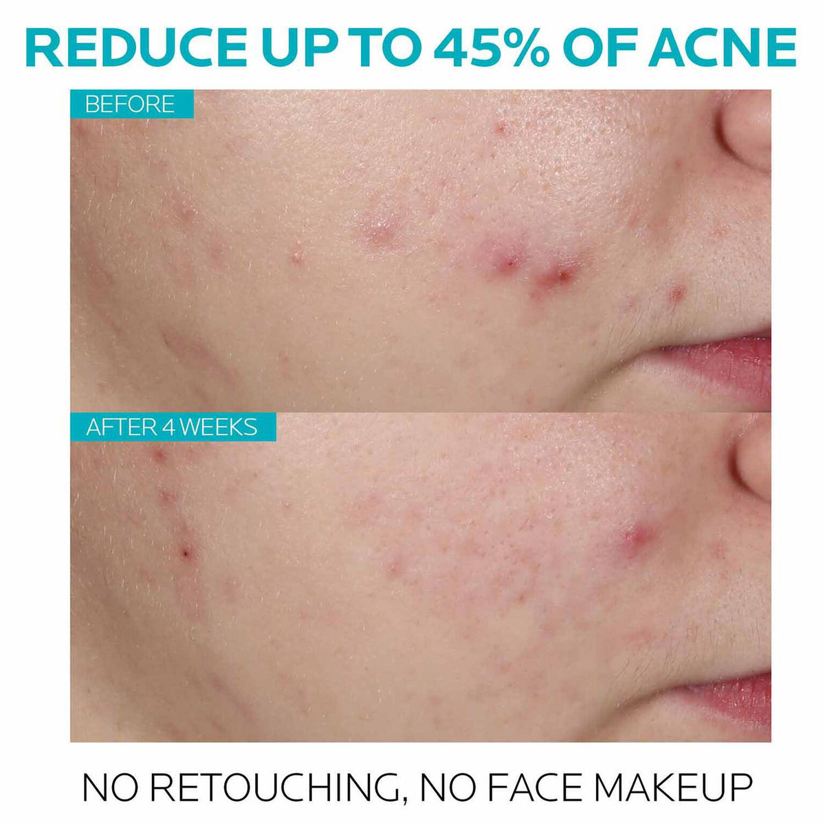 effaclar-salicylic-acid-acne-treatment-serum-r5 7_EffaclarSerum_After-45-days.jpg 7_EffaclarSerum_After-45-days_861b20986157.jpg