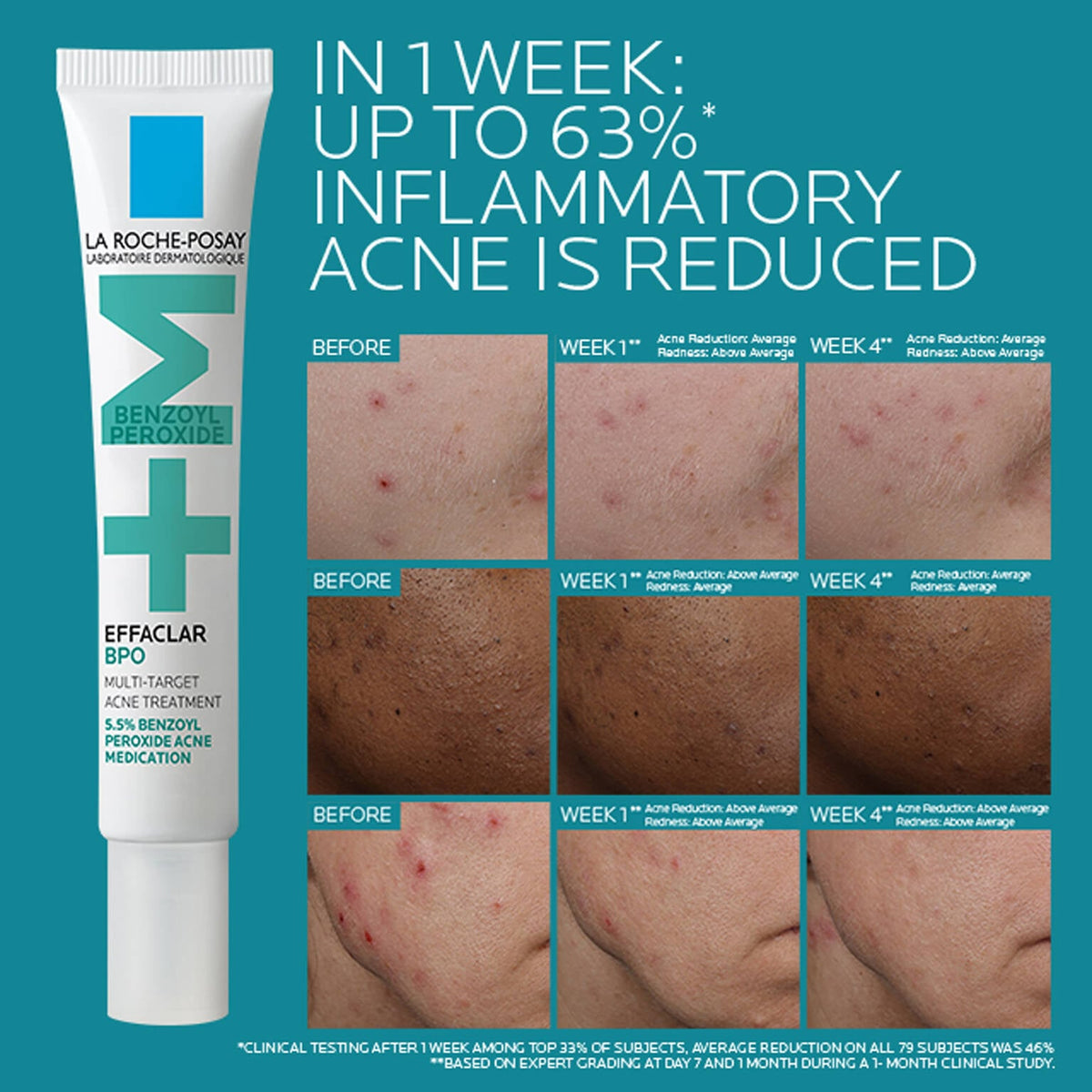 effaclar-bpo-multi-target-acne-treatment-with-5-5-benzoyl-peroxide-t5 EffaclarBPO-ClinicalBA-ATF-1500x1500-2.jpg EffaclarBPO-ClinicalBA-ATF-1500x1500-2_24504e8de09c.jpg
