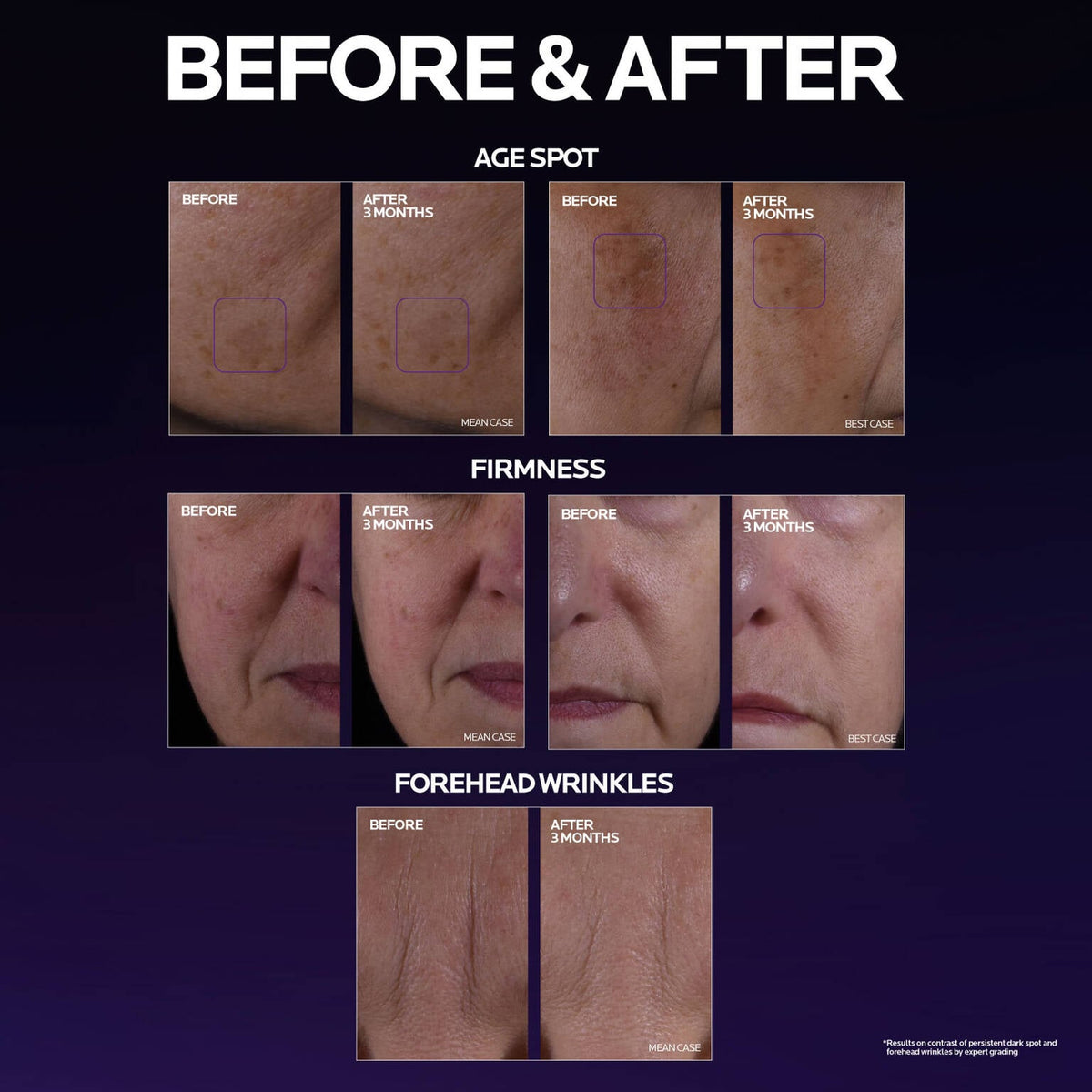 mela-b3-double-dose-discoloration-treatment-with-melasyltm-n7 MelaB3_DD_BTF_BeforeAfter_1500x1500_5.jpg MelaB3_DD_BTF_BeforeAfter_1500x1500_5_eb9d4f5b0787.jpg